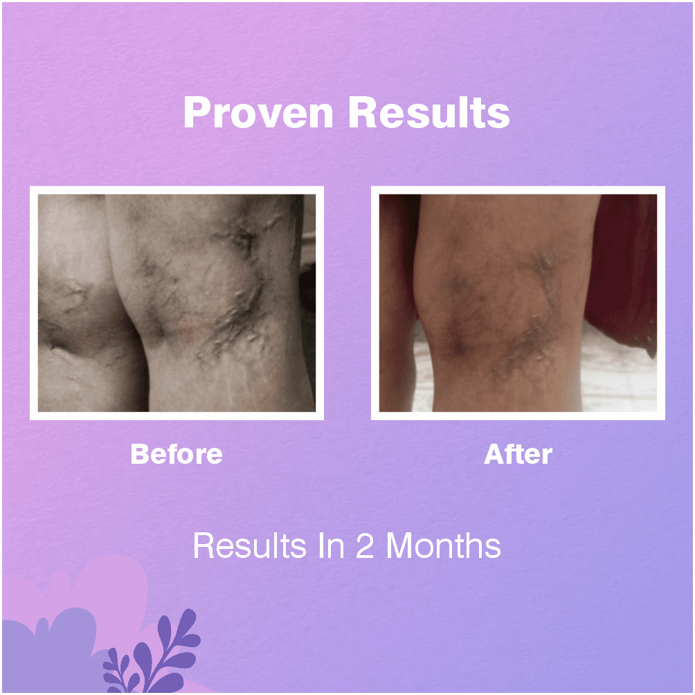 Varicose Veins Lotion Results Varicose Veins Lotion Results