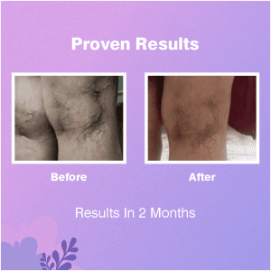 Ayurvedic medicine for varicose veins Var-Erase lotion
