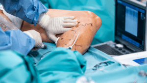 Best Ayurvedic Treatment for Varicose Veins.png