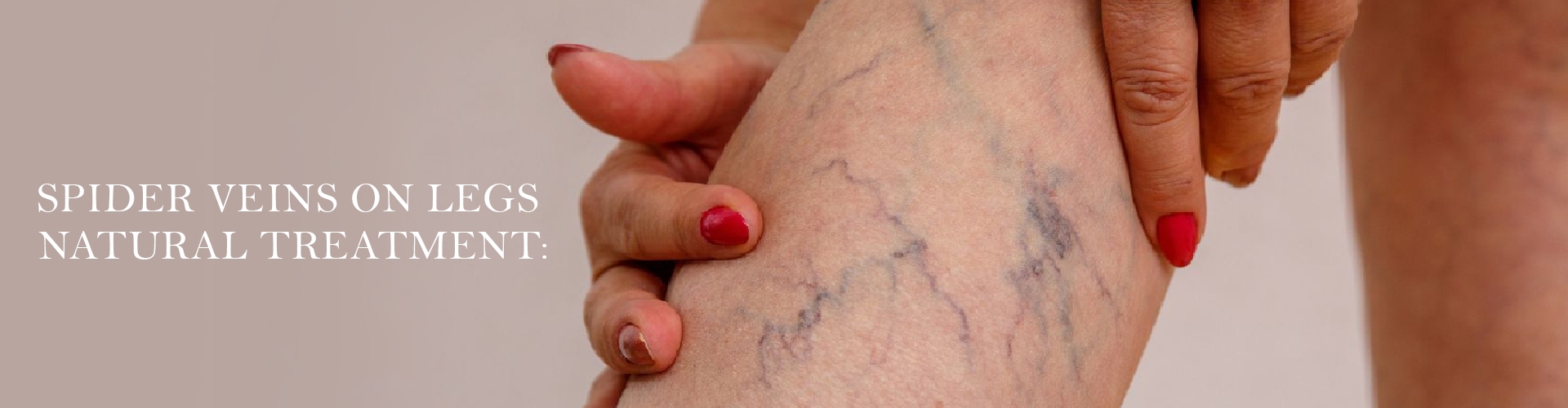 SPIDER VEINS ON LEGS NATURAL TREATMENT BANNER