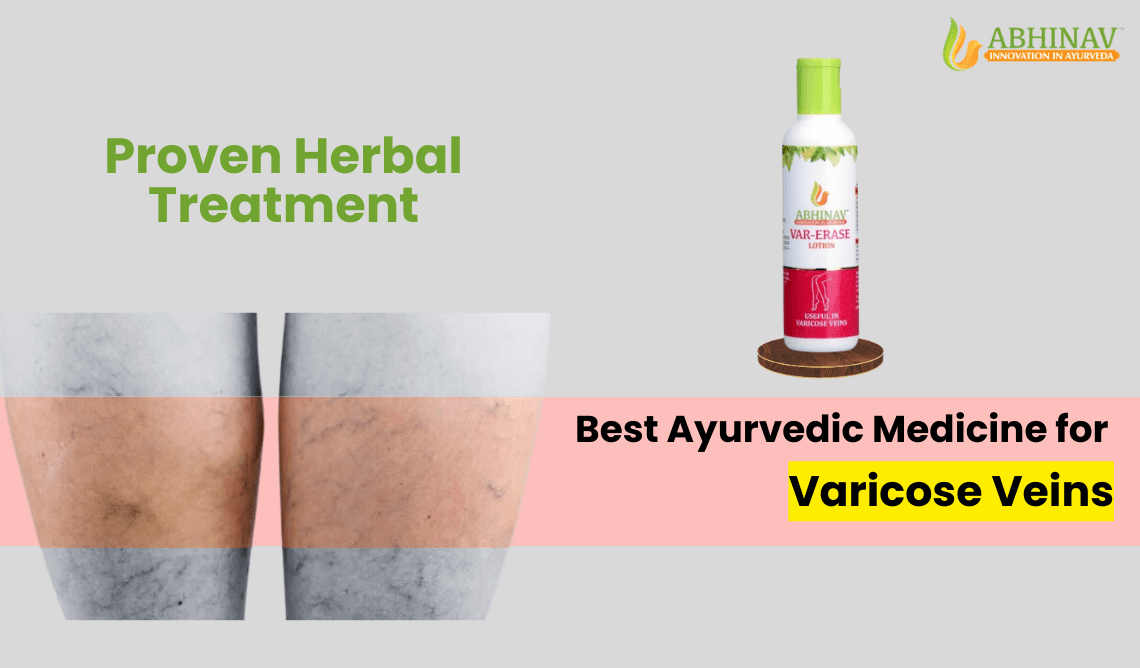 Best Ayurvedic Medicine for Varicose Veins – Proven Herbal Treatment