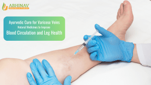 Varicose veins treatment on leg using natural therapy